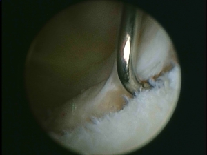 Shoulder arthroscopy showing a labral tear