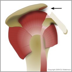 Rotator cuff pain treated by arthroscopic subacromial decompression