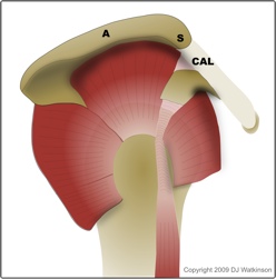subacromial impingement caused by subacromial spur