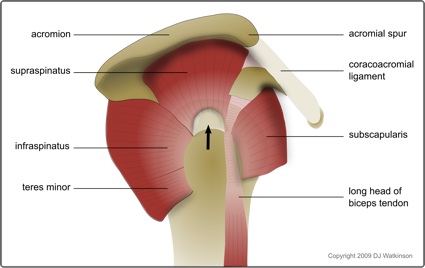 Rotator cuff tear affecting the supraspinatus tendon