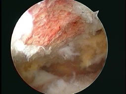 completed arthroscopic subacromial decompression
