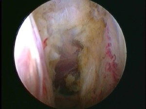arthroscopic capsular release of frozen shoulder