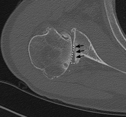 Severe shoulder arthritis